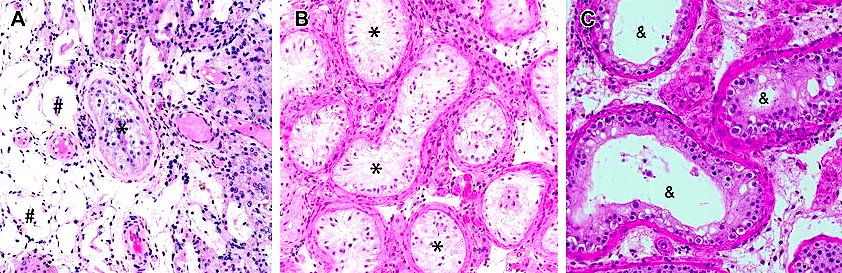 Tubule Azoospermia